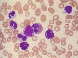 FDA宣布暫停銷售白血病治療藥物ponatinib
